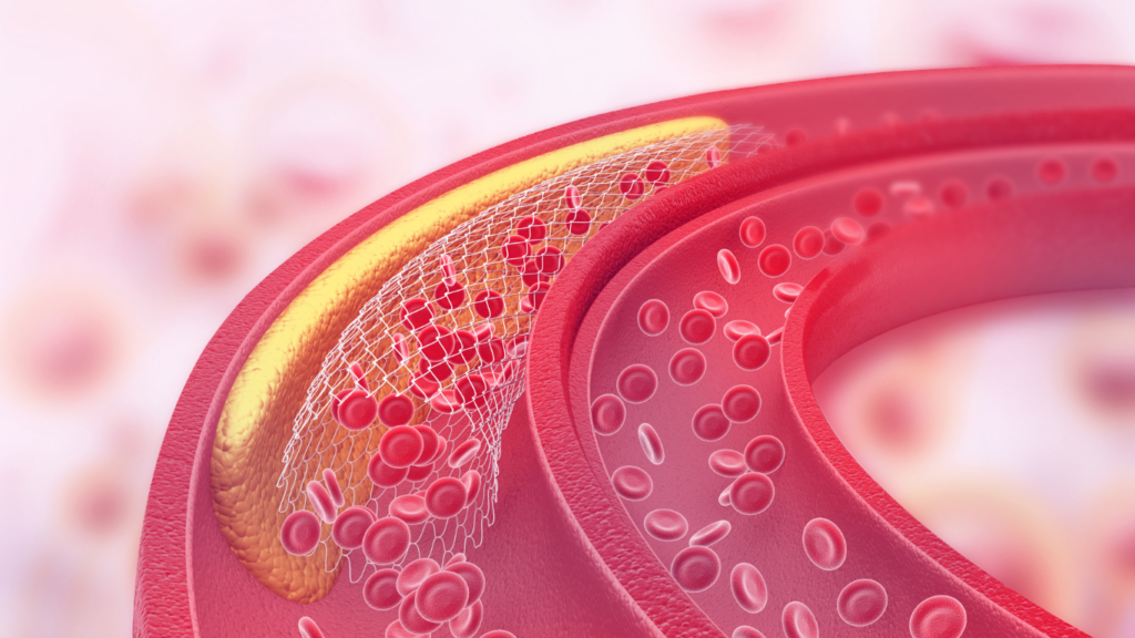 infografía del interior de una arteria con colesterol